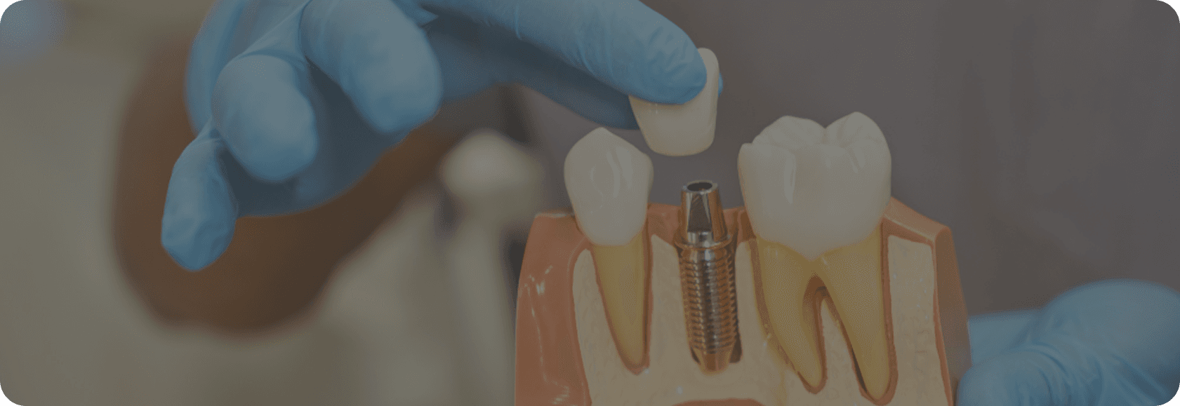 Dental implants banner