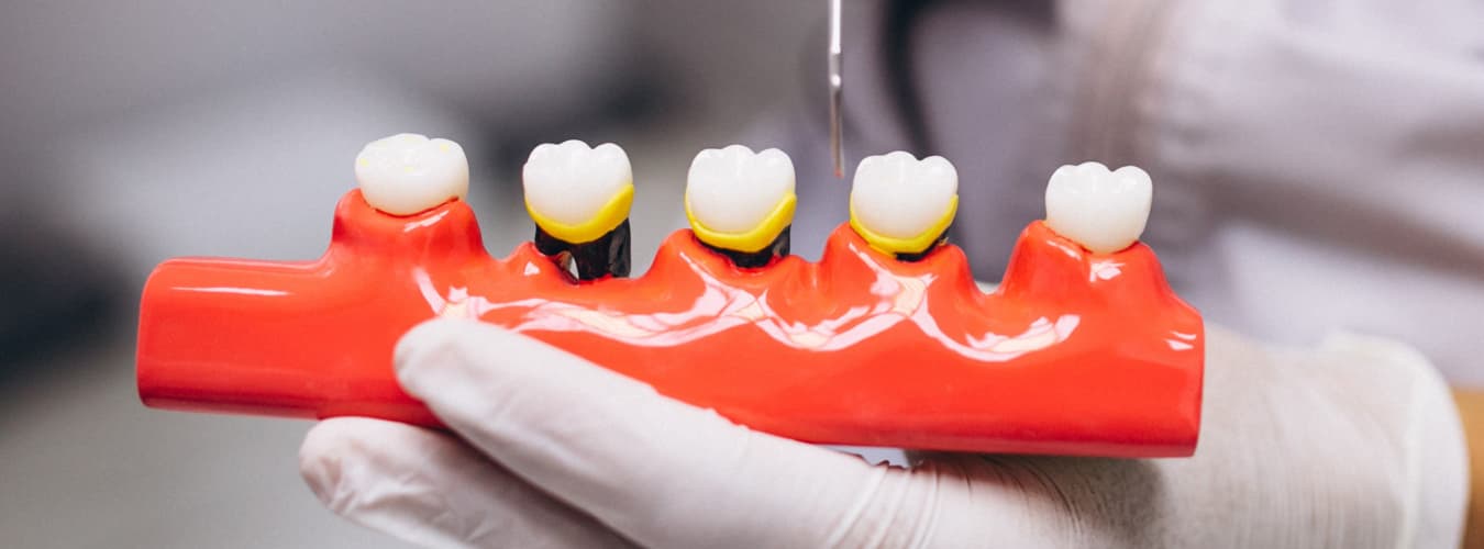 Dental-crowns-