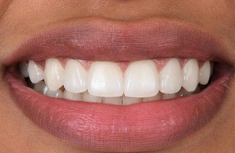 After - Teeth Gap Before