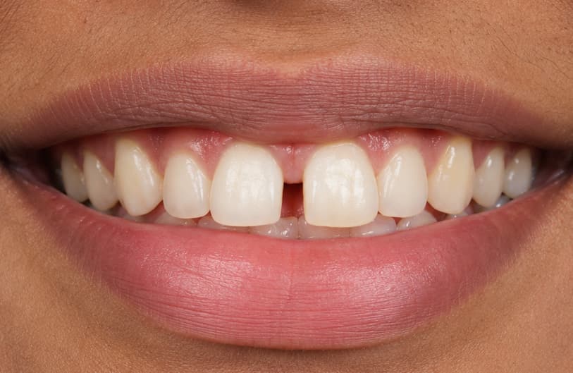 Before - Teeth Gap Before