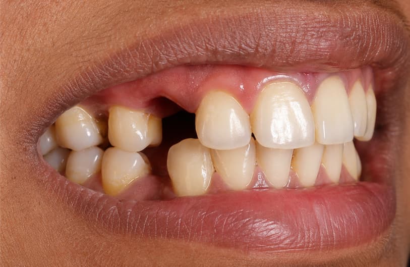 After - atraumatic extraction before