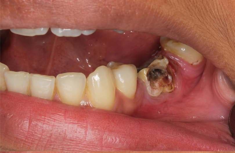 Before - atraumatic extraction before