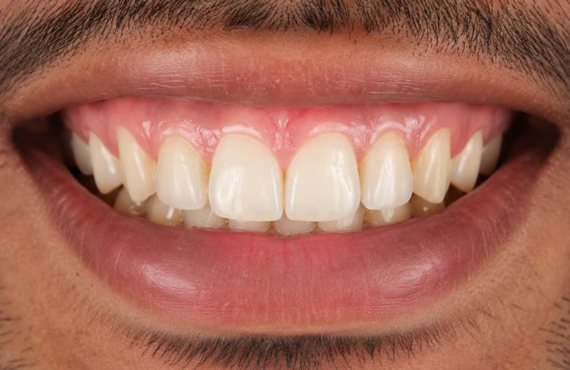 After - laser gum treatment before