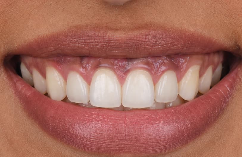 Before - laser gum treatment before