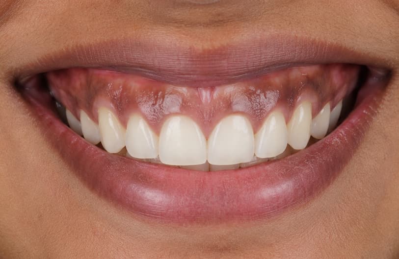 Before - laser gum treatment before
