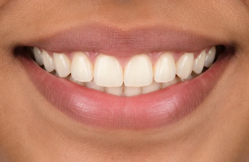 After - orthodontic treatment before