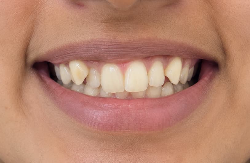 Before - orthodontic treatment before