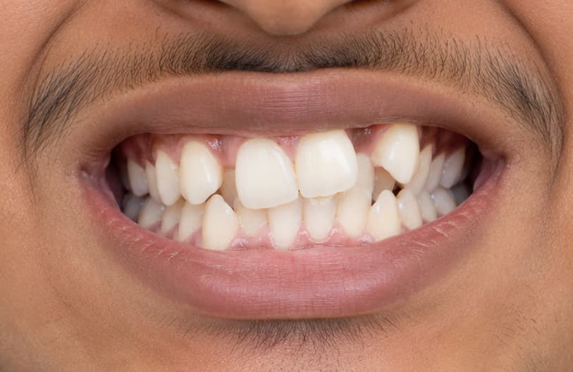 Before - orthodontic treatment before