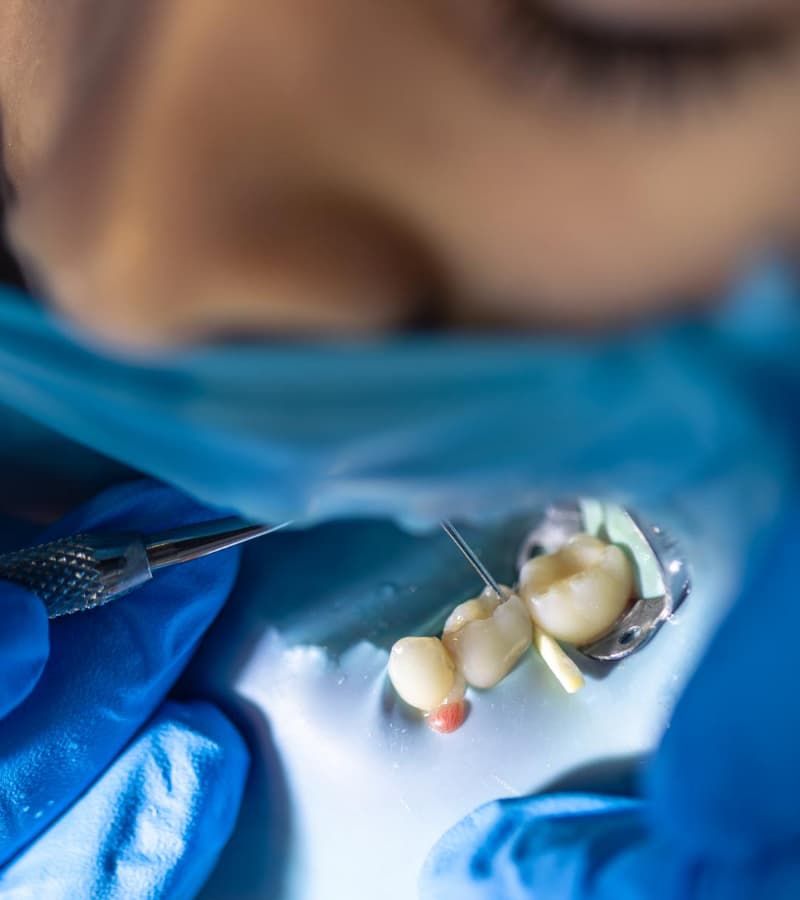 same-day-CEREC-treatment