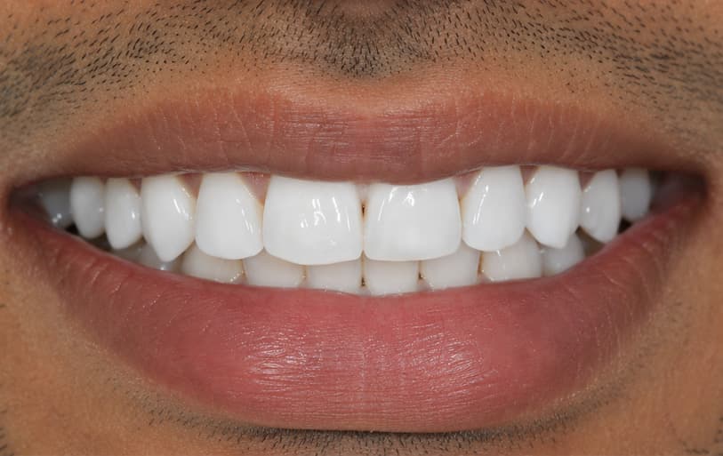 After - teeth whitening before