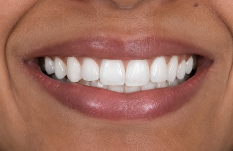 After - teeth whitening before