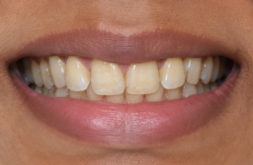 Before - teeth whitening before