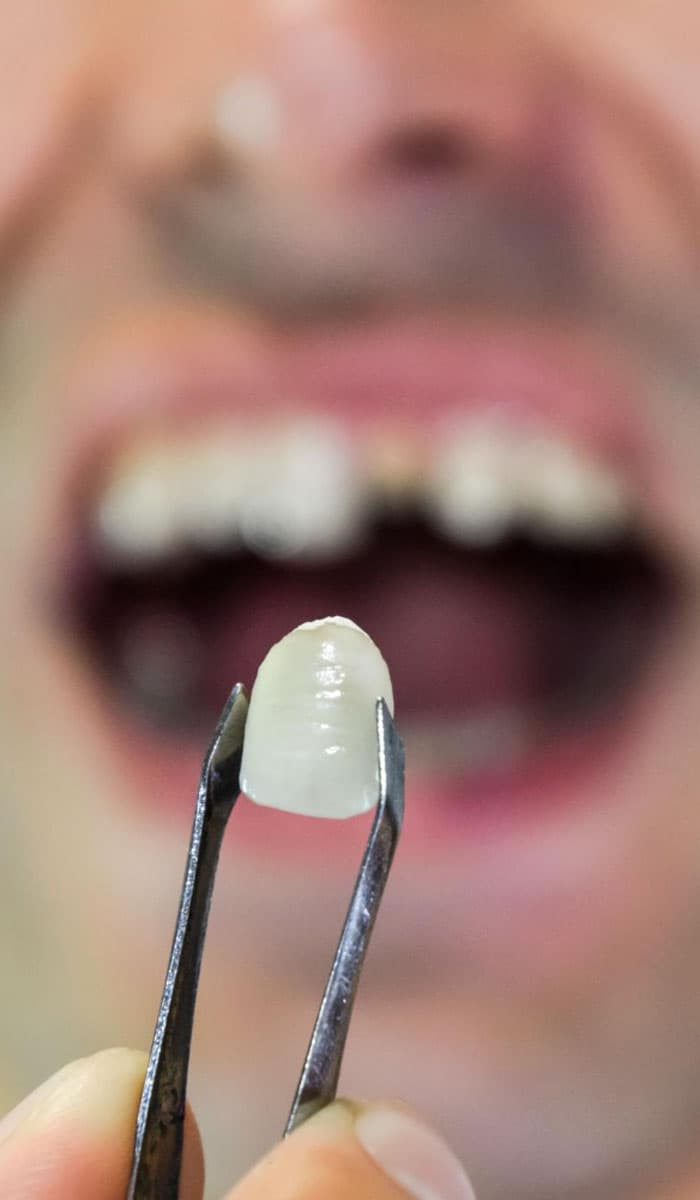 benefits-of-dental-cap-treatment