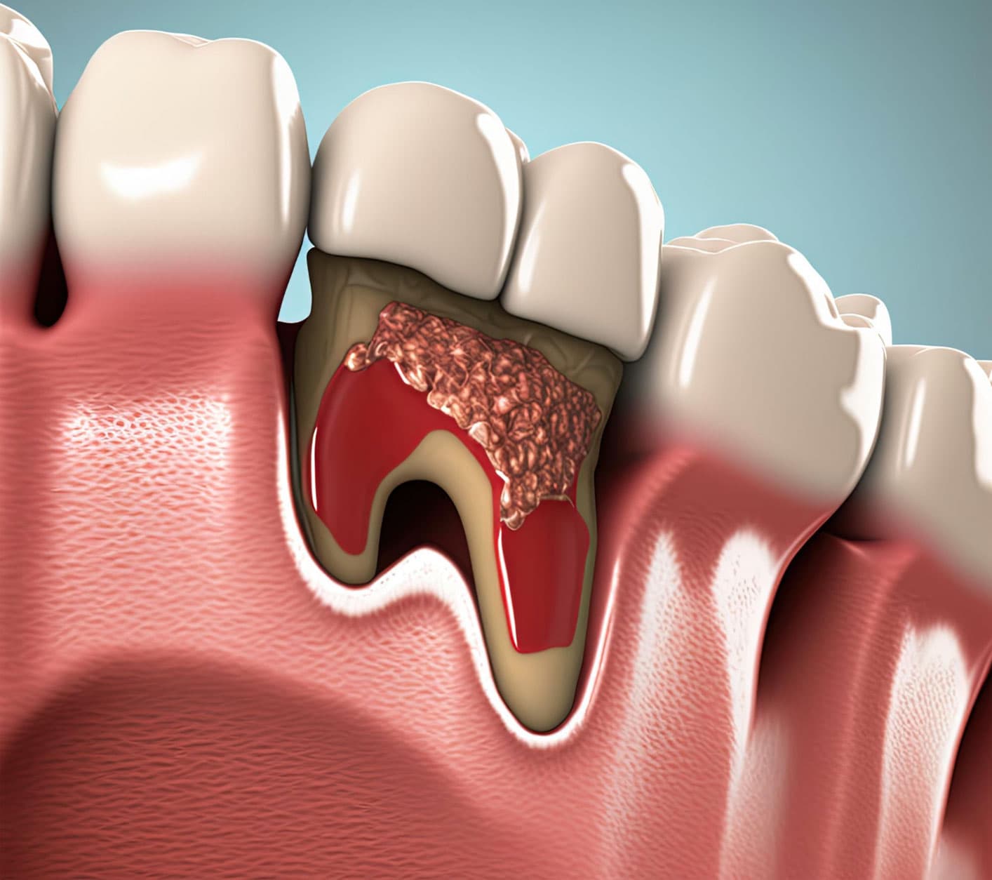 how-flap-surgery-protects-your-gums