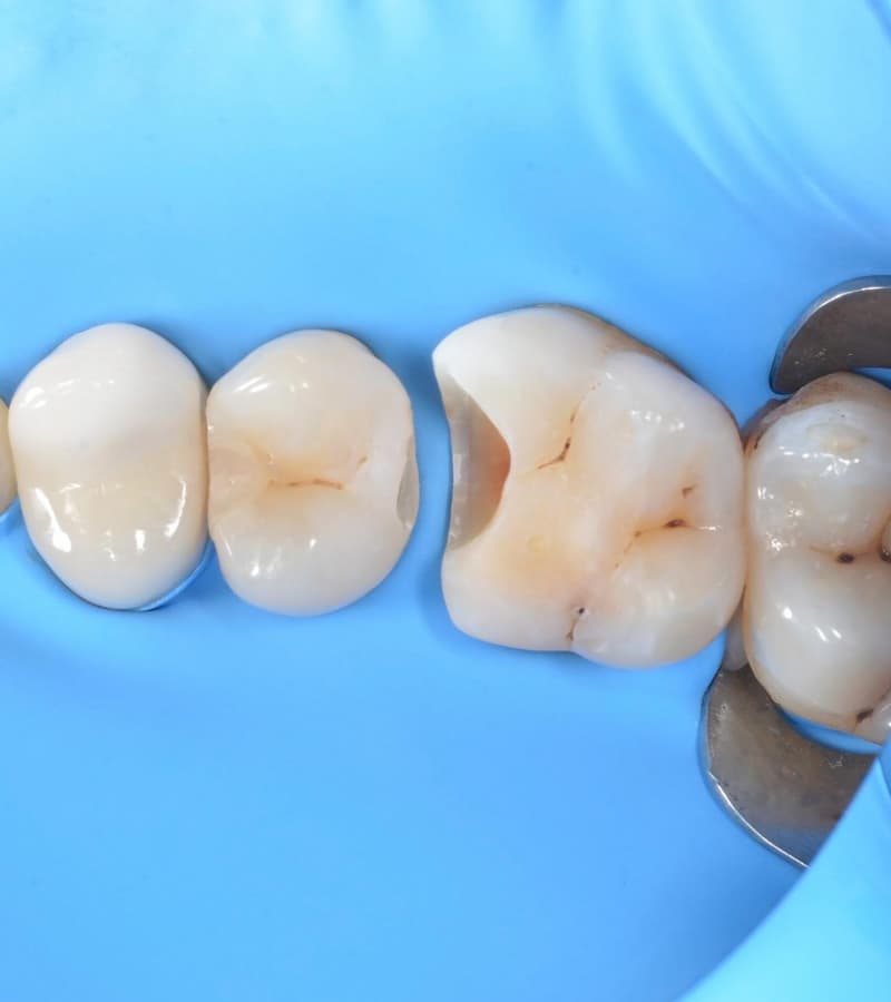 first-visit-and-tooth-preparations
