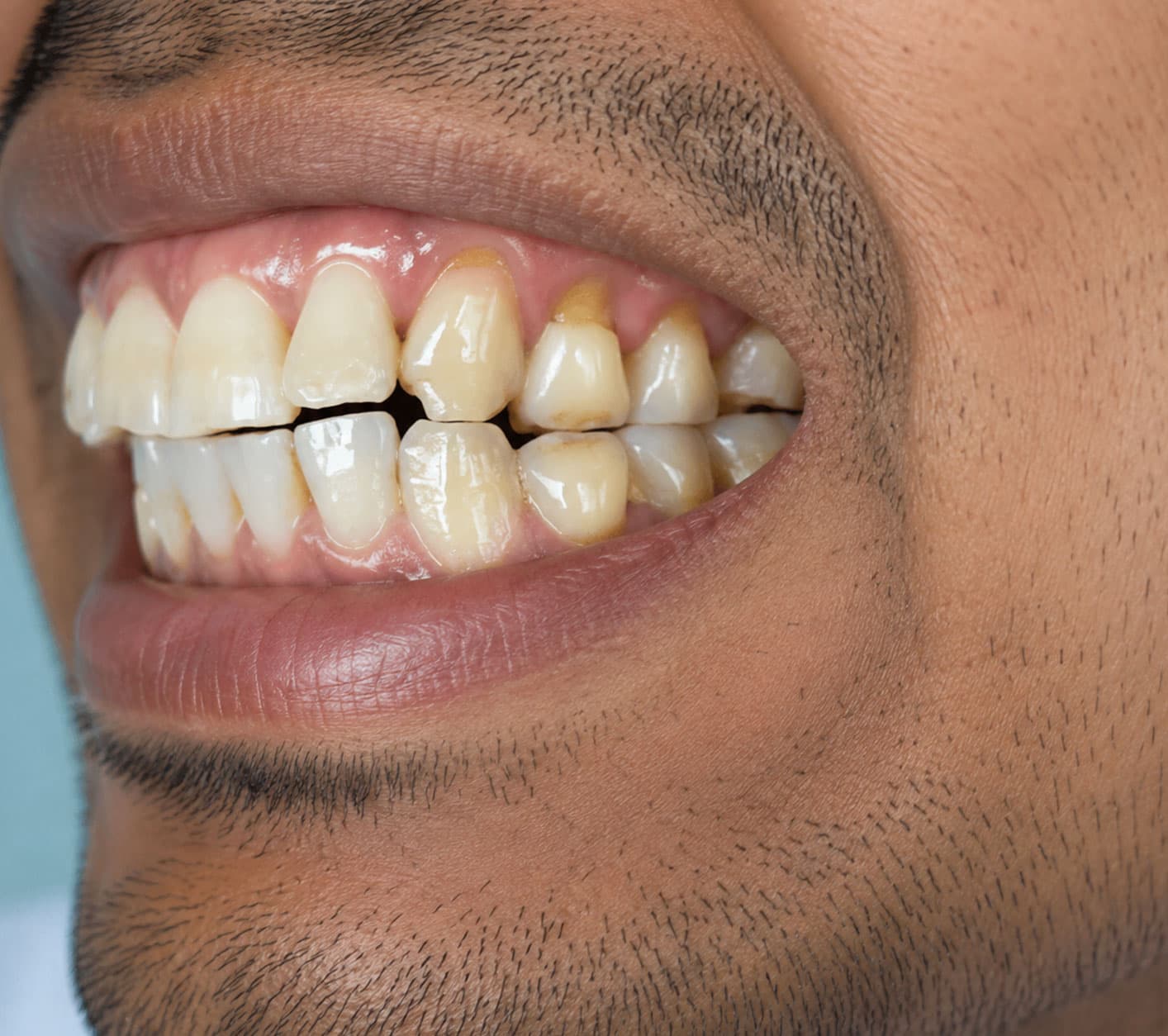 dental-erosion-treatment-cost-in-hyderabad