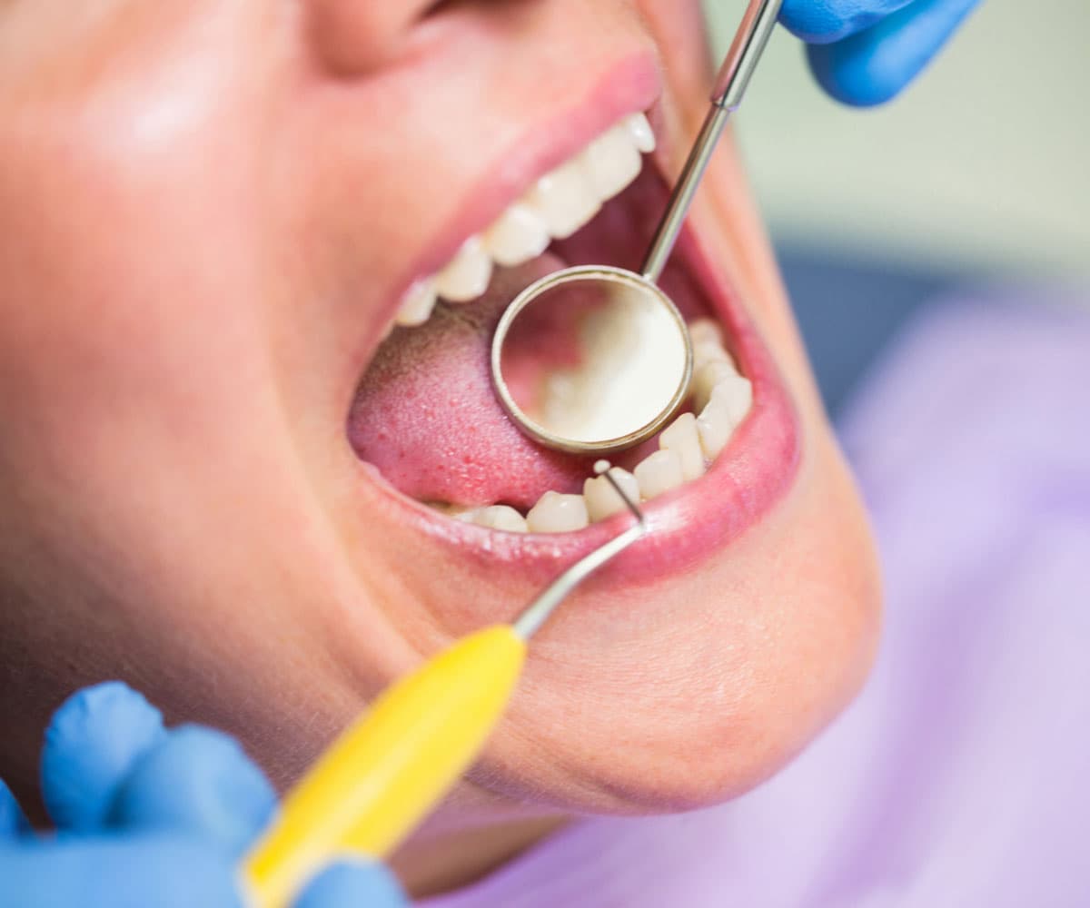 fluorosis-treatment-or-simple-whitening