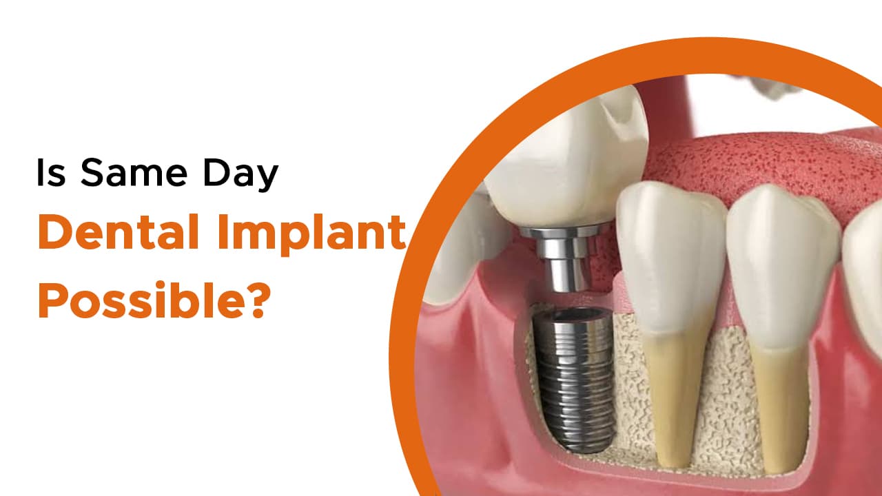 Is Same Day Dental Implant Possible?