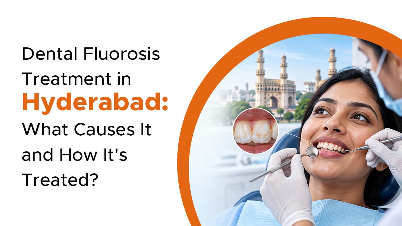 Dental Fluorosis Treatment in Hyderabad: What Causes It and How It is Treated?