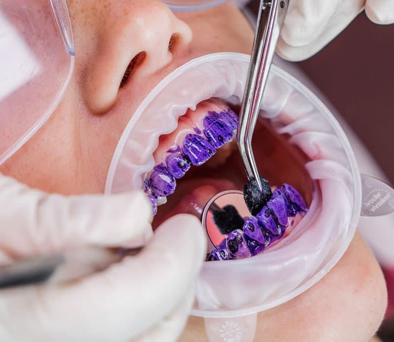 Zoom teeth whitening treatment