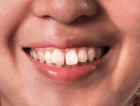 After - Celebrity-Smiles