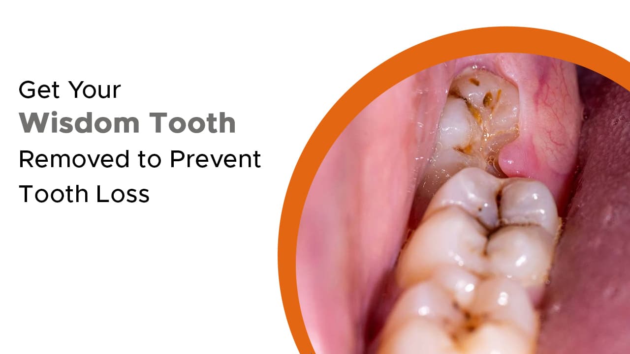 Get Your Wisdom Tooth Removed to Prevent Tooth Loss