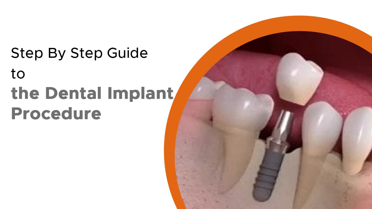 Step By Step Guide to the Dental Implant Procedure