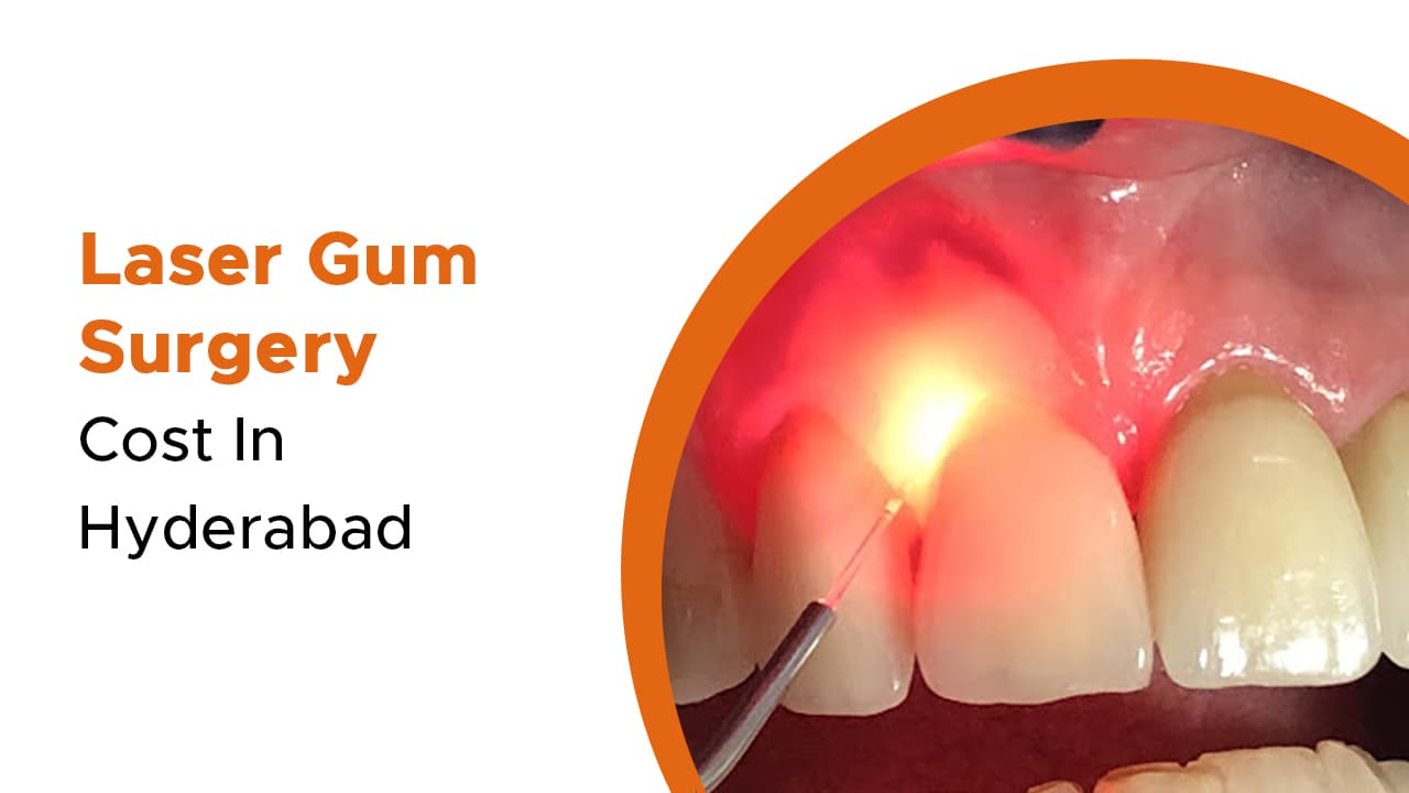 Laser Gum Surgery Cost In Hyderabad