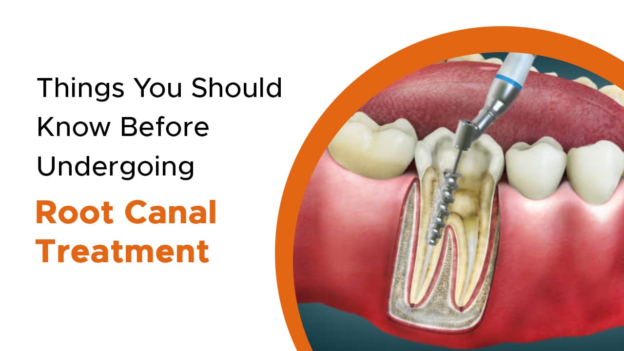 Things You Should Know Before Undergoing Root Canal Treatment