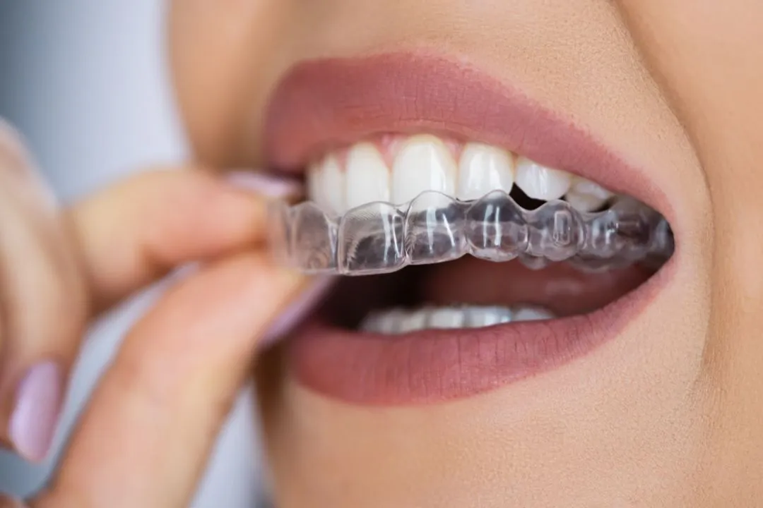 Braces